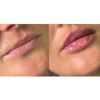 Achieve a Defined Look With Fillers. with Complimentary Consultation