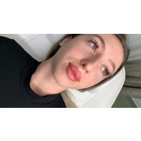 0.55 ml or 1 ml Lip Dermal Filler at Queen of Lips with 2 locations
