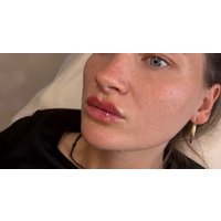 Injection - Dermal Filler