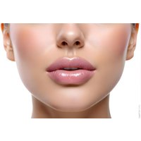 1ml Dermal Lip Filler Treatment at Vital Aesthetics - Sutton Coldfield | Things To Do