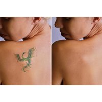 Laser Tattoo Removal - Choice of Area at 1118 IPL & Beauty Salon, Leicester | Things To Do