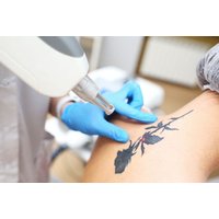 Laser Tattoo Removal - Size Options - Forever Face Clinic, Cardiff | Things To Do