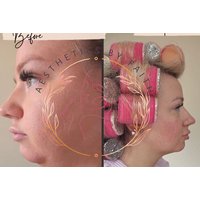Lemon Bottle Fat Dissolving Treatment - Aesthetics by Faith, Brentwood | Things To Do