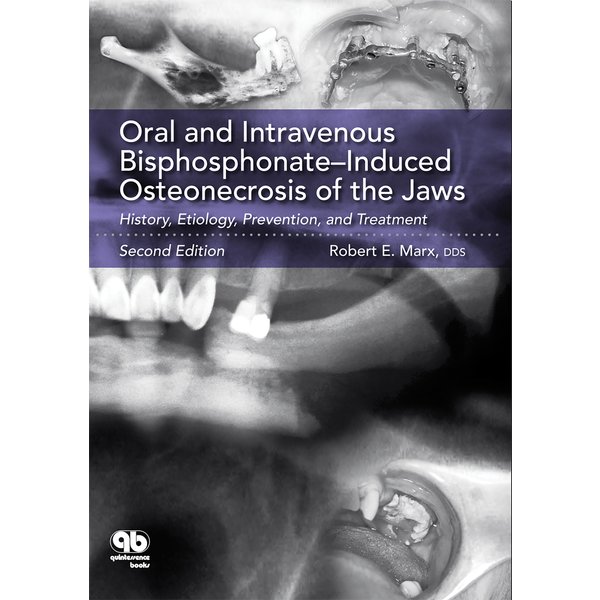 Oral and Intravenous Bisphosphonate–Induced Osteonecrosis of the Jaws