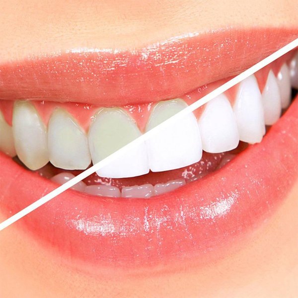 Kit Blanqueamiento Dental Profesional Kit De Gel Oral Dental Blanqueamiento Dental Equipo Dental-image