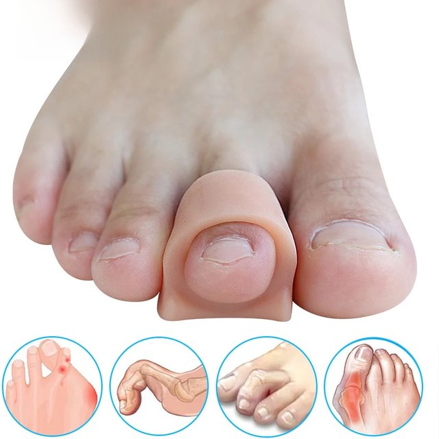 Pexmen 2/4/10Pcs Soft Gel Toe Separators Toe Spacers Bunion Corrector for Overlapping Hallux Valgus and Hammertoe Foot Care Tool
