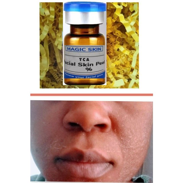 TCA 20% 30% 40% 50% 60% 70% 90% 100% PEAU FACIAL Solution DE PERLAGE CHEMIQUE Exfoliante