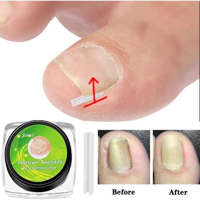 Nail Ingrown Corrector Nail Patch Correction Tube Pad Patch Corrector Nail Treatments Toenail Straightening Correctors Foot Care