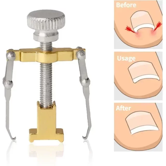 Ingrown Toenail Corrector Straightening Clip Pedicure Foot Nail Care Tools Stainless Steel Pedicure Treatment Onyxis Correction