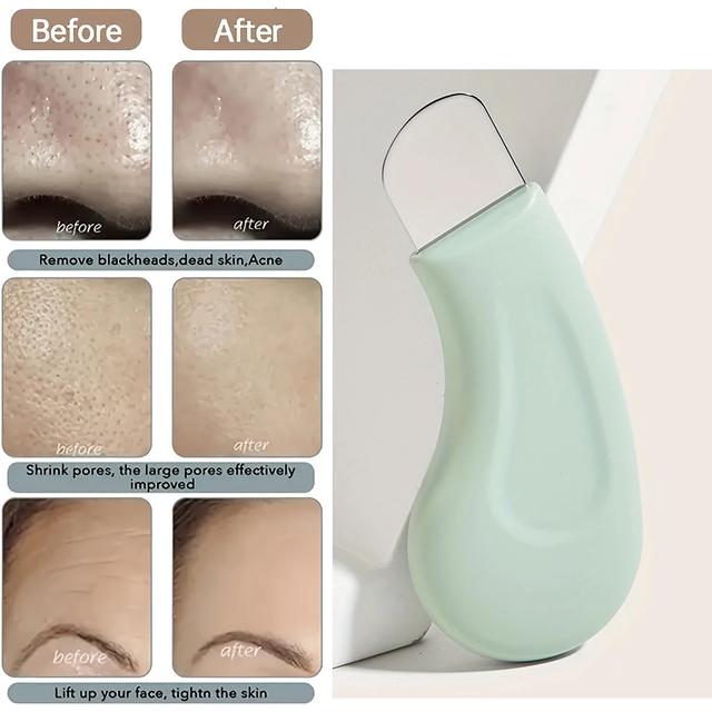 Blackhead and Whitehead Removal Tool for Nose and Face - Skin Pore Cleaner Skin Care Beauty Tools