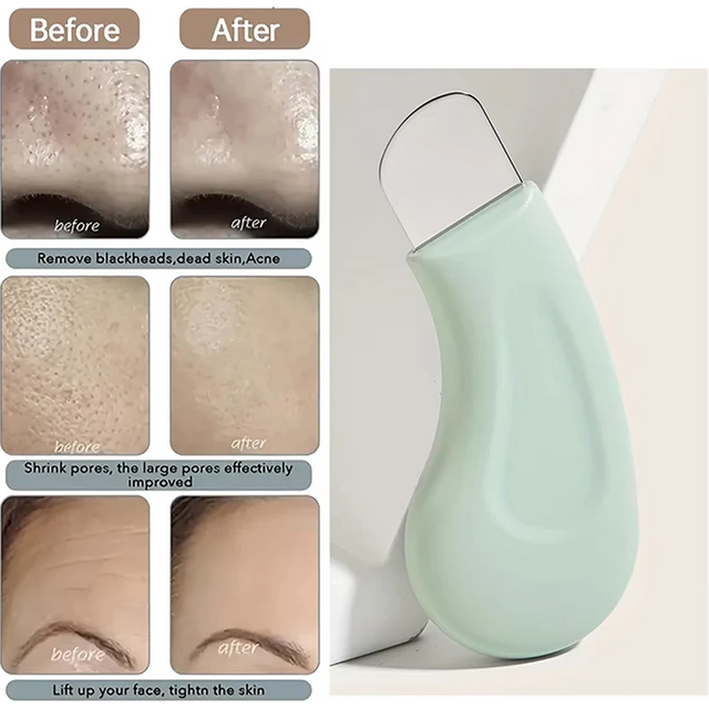 Blackhead and Whitehead Removal Tool for Nose and Face Skin Pore Cleaner Scraper Dead Skin Care Beauty Tools for women