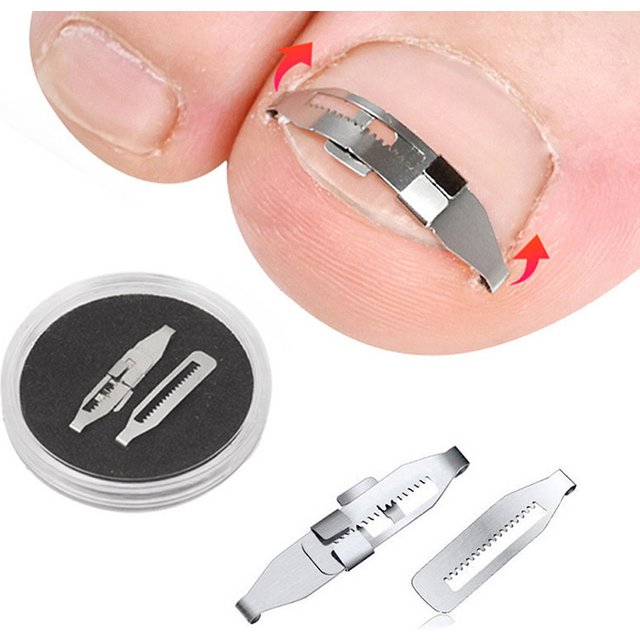 Ingrown Toenail Corrector Tools Pedicure Recover Embed Toe Nail Treatment Professional Ingrown Toenail Correction Foot Care Tool