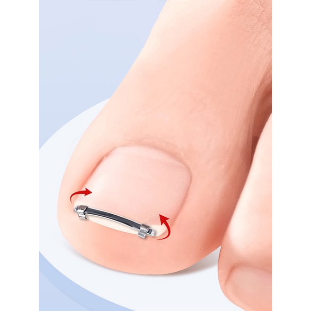 Curved Clamp Ingrown Toenail Pedicure Tool Toe Nail Care Straightening Correction Clip Embed Nail Care Tool for Toes