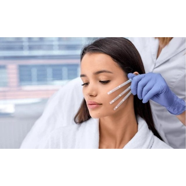 Sesión de lifting facial con 6 hilos tensores monofilamento