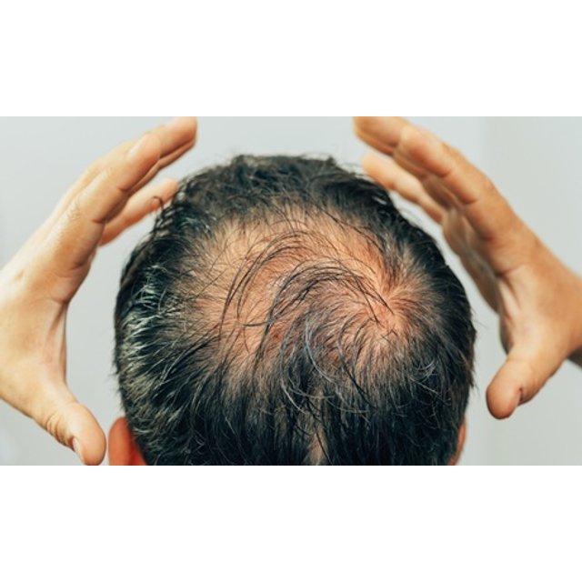 1 sesión de tratamiento capilar con mesoterapia