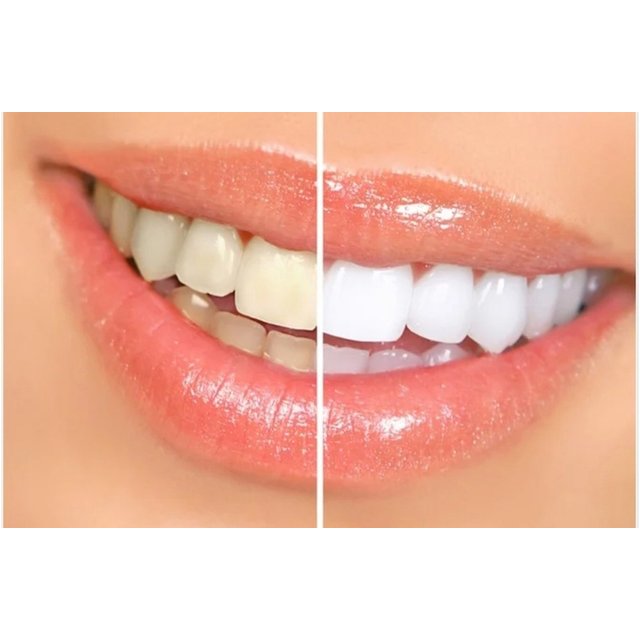 Teeth Whitening Treatment at Studio hair & co