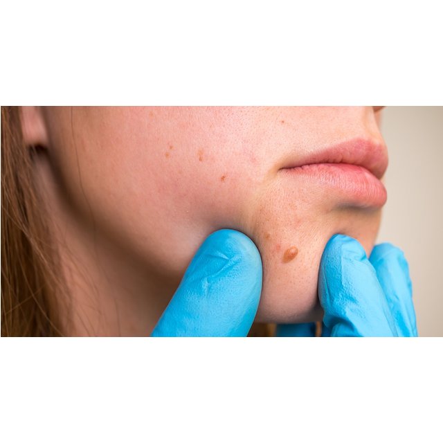 Two Skin Tag Removals