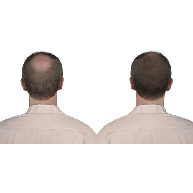 PRP Hair Growing Stimulation