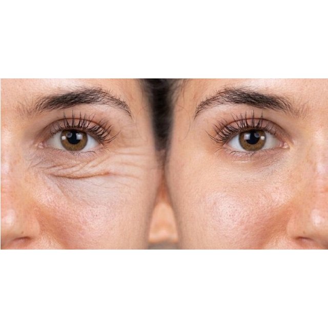 Ojeras / Tratamiento del párpado
