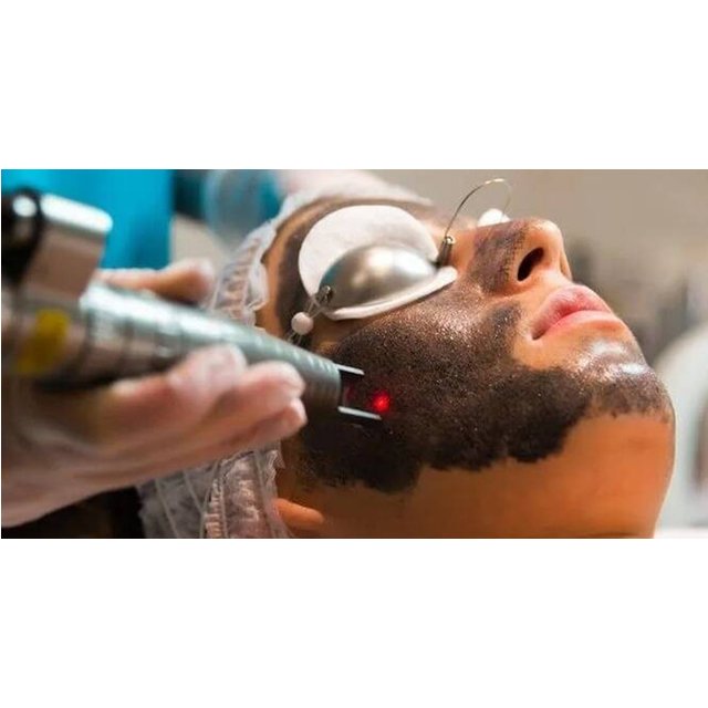 Tratamiento facial - Peeling