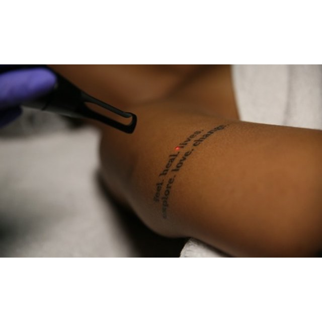 2 sesiones de eliminación de tatuaje 5x5cm