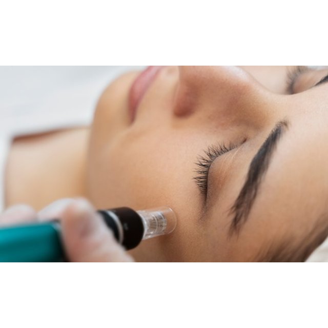 Sesión de microneedling facial con vitamina C y limpieza facial completa