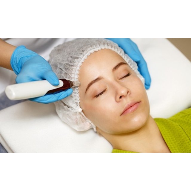 1 sesión de microlifting facial de vitaminas con Dermapen