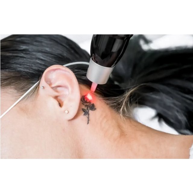 3 sesiones de eliminación de tatuajes con láser hasta 100 cm²