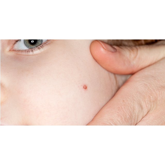 Electrocautery: Removal of Skin Tags, Warts, Sebaceous Cysts - 1 Piece