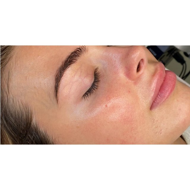 Facial - HydraFacial