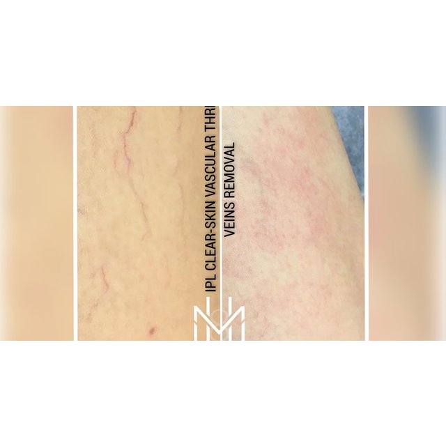 Spider Vein Removal - IPL