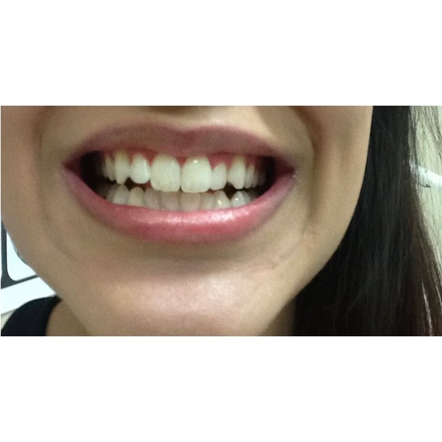 In-Chair LED Teeth Whitening