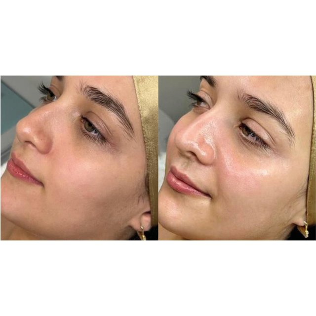 Facial - Chemical Peel